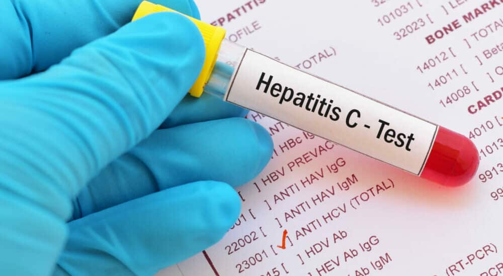 hepatitis C,diagnóstico,OMS